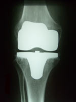 Oberflächenprothese